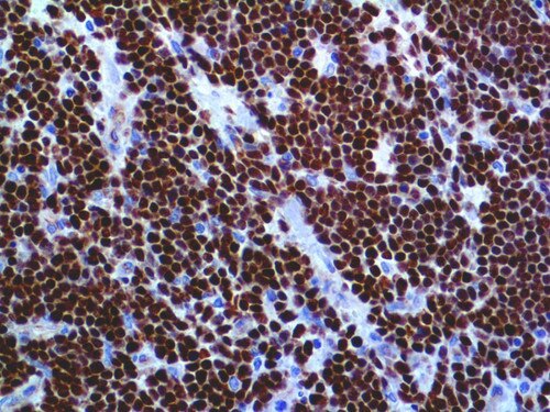 IHC of TdT on an FFPE Lymphoblastic Lymphoma Tissue
